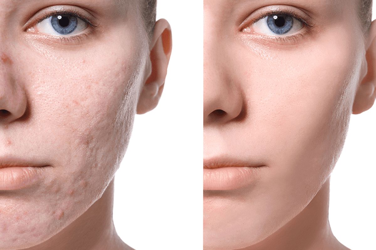 Hyperpigmented skin facial
